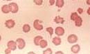 Células sangüíneas de uma pessoa com anemia