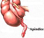 Apêndice: inflamação requer cirurgia para extração