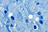 Mycobacterium leprae: bactéria causadora da Hanseníase (imagem ampliada por microscópio)
