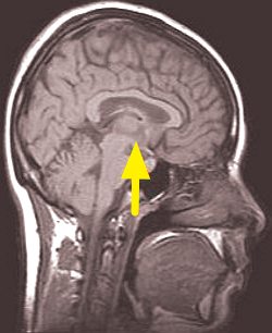 Ilustração mostrando a localização do hipotálamo no cérebro humano