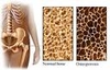 Osso normal (a esquerda) e com osteoporose (a direita)