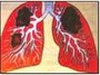 Tuberculose pulmonar: causada pelo bacilo de Koch